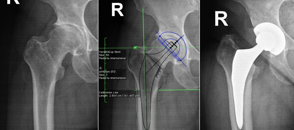Arthrotisch verändertes Hüftgelenk (links), computergestützte Planung der Prothese (Mitte), postoperative Röntgenkontrolle (rechts)